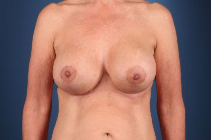 Breast Revision Before & After Image