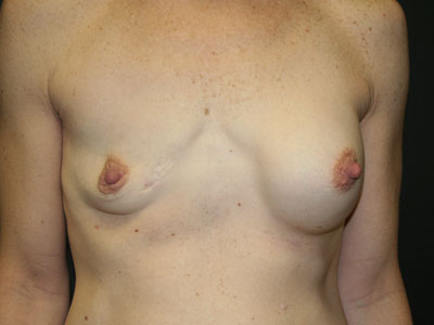 Congenital Breast Deformity Before & After Image