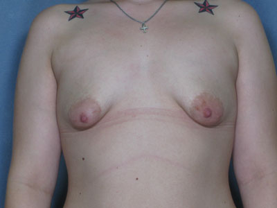 Congenital Breast Deformity Before & After Image