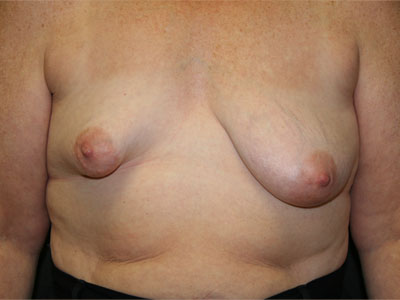 Congenital Breast Deformity Before & After Image