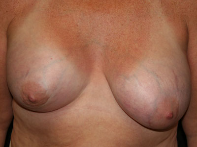 Congenital Breast Deformity Before & After Image