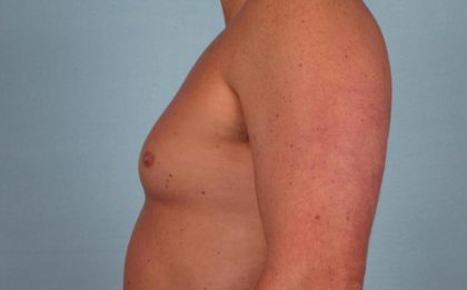 Gynecomastia Surgery Before & After Image