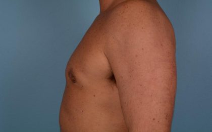 Gynecomastia Surgery Before & After Image