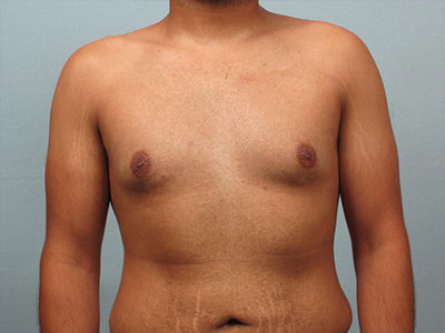 Gynecomastia Surgery Before & After Image