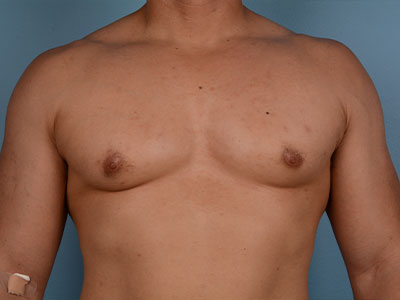 Gynecomastia Surgery Before & After Image