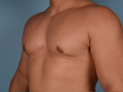 Gynecomastia Surgery Before & After Image