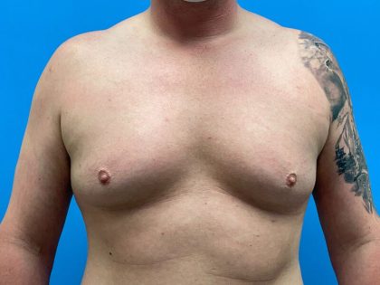 Gynecomastia Surgery Before & After Image