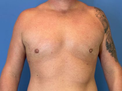 Gynecomastia Surgery Before & After Image