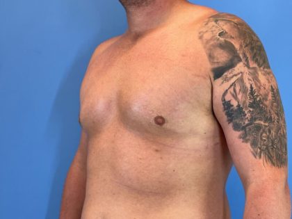 Gynecomastia Surgery Before & After Image