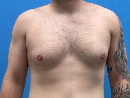 Gynecomastia Surgery Before & After Image