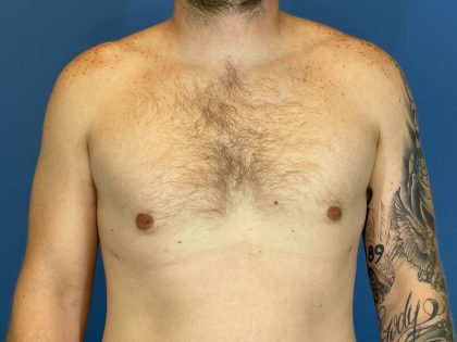 Gynecomastia Surgery Before & After Image