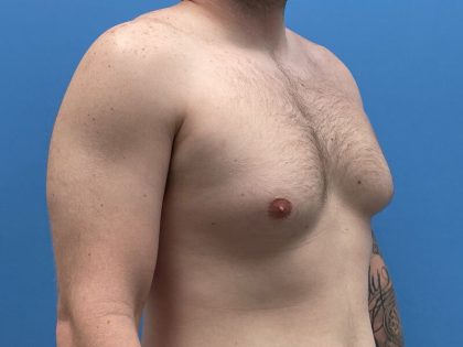 Gynecomastia Surgery Before & After Image