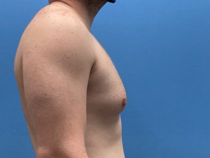 Gynecomastia Surgery Before & After Image