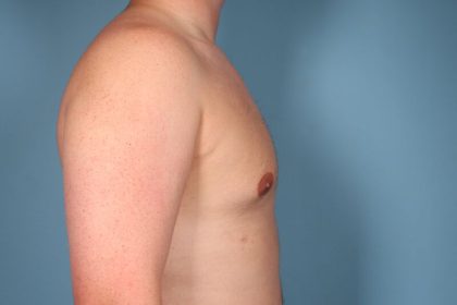 Gynecomastia Surgery Before & After Image