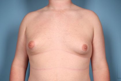 Gynecomastia Surgery Before & After Image