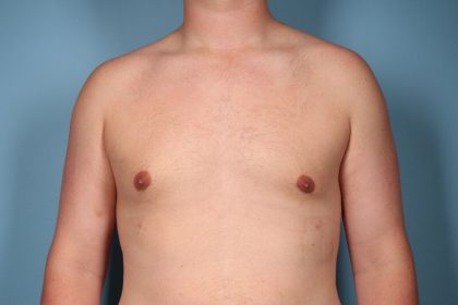 Gynecomastia Surgery Before & After Image