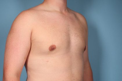 Gynecomastia Surgery Before & After Image