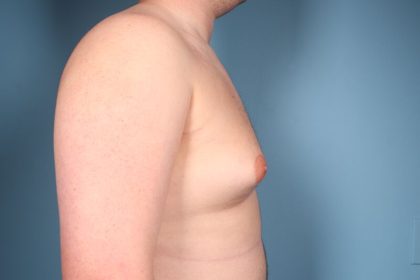 Gynecomastia Surgery Before & After Image