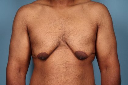 Gynecomastia Surgery Before & After Image