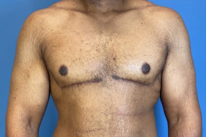 Gynecomastia Surgery Before & After Image