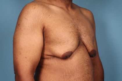 Gynecomastia Surgery Before & After Image