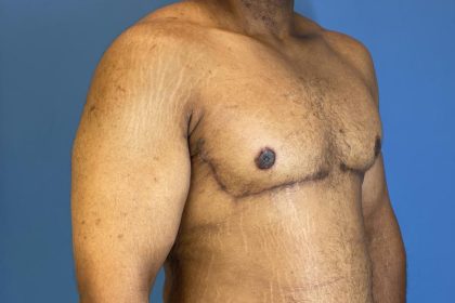 Gynecomastia Surgery Before & After Image