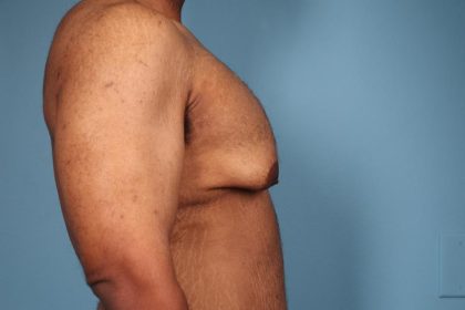 Gynecomastia Surgery Before & After Image