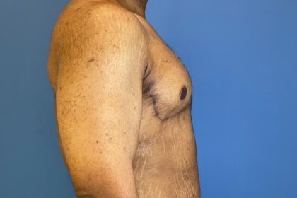 Gynecomastia Surgery Before & After Image