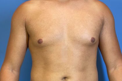 Gynecomastia Surgery Before & After Image