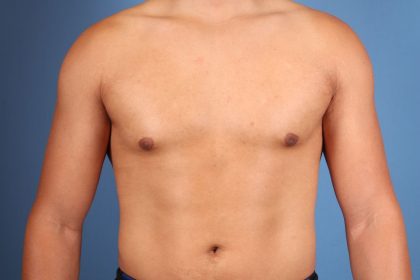 Gynecomastia Surgery Before & After Image