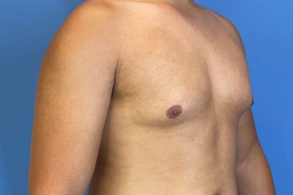 Gynecomastia Surgery Before & After Image