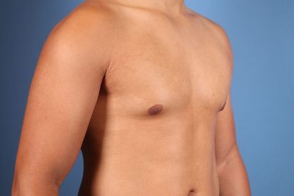 Gynecomastia Surgery Before & After Image