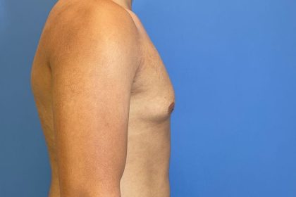 Gynecomastia Surgery Before & After Image