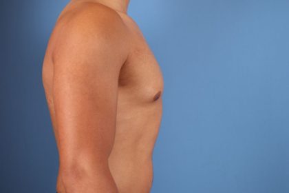 Gynecomastia Surgery Before & After Image