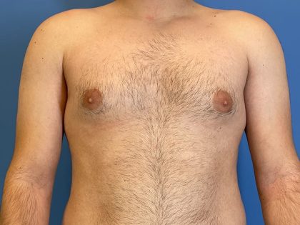 Gynecomastia Surgery Before & After Image