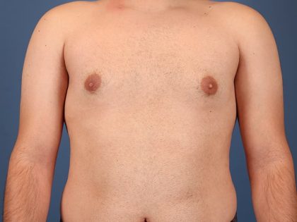 Gynecomastia Surgery Before & After Image