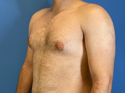 Gynecomastia Surgery Before & After Image