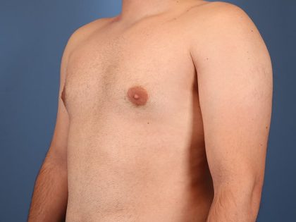 Gynecomastia Surgery Before & After Image