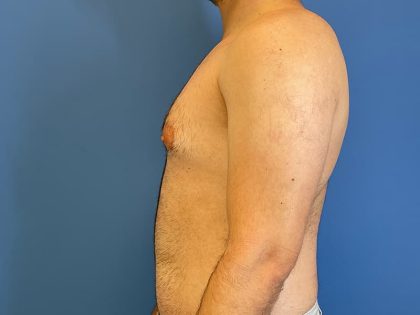 Gynecomastia Surgery Before & After Image