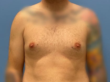 Gynecomastia Surgery Before & After Image