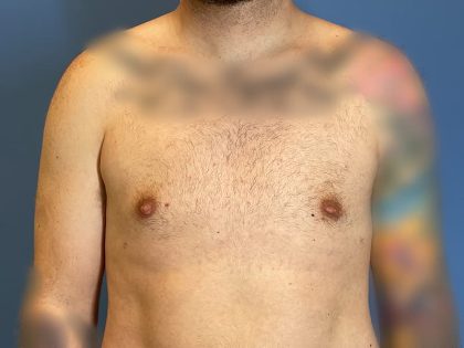 Gynecomastia Surgery Before & After Image