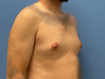 Gynecomastia Surgery Before & After Image