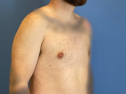 Gynecomastia Surgery Before & After Image