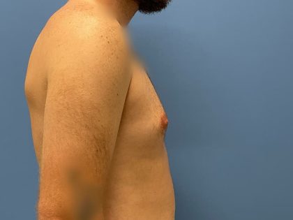 Gynecomastia Surgery Before & After Image