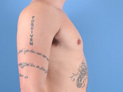 Gynecomastia Surgery Before & After Image