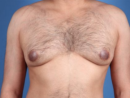 Gynecomastia Surgery Before & After Image