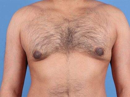 Gynecomastia Surgery Before & After Image