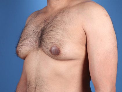 Gynecomastia Surgery Before & After Image