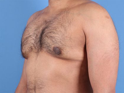 Gynecomastia Surgery Before & After Image