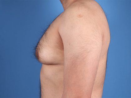 Gynecomastia Surgery Before & After Image